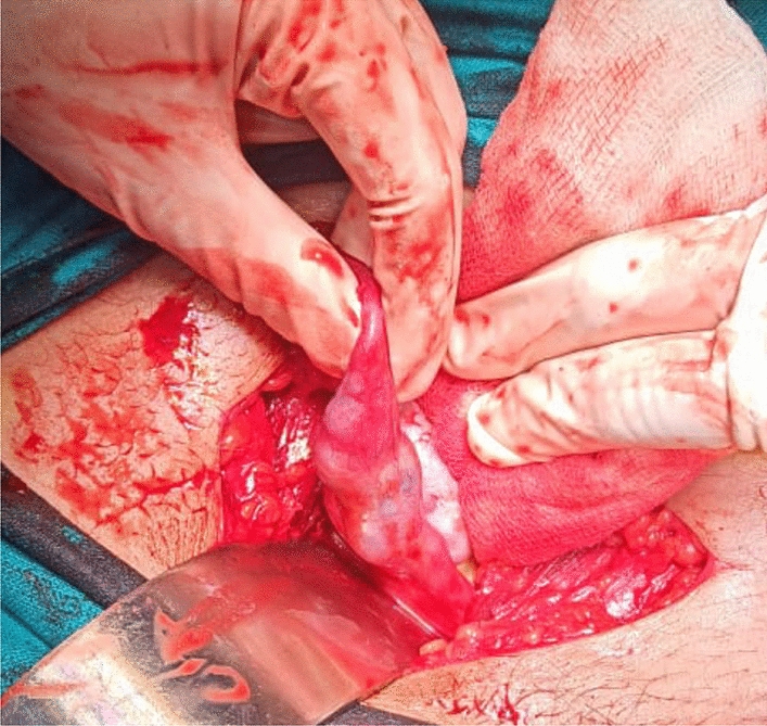 Struma Salpingis with Tubal Ectopic Pregnancy