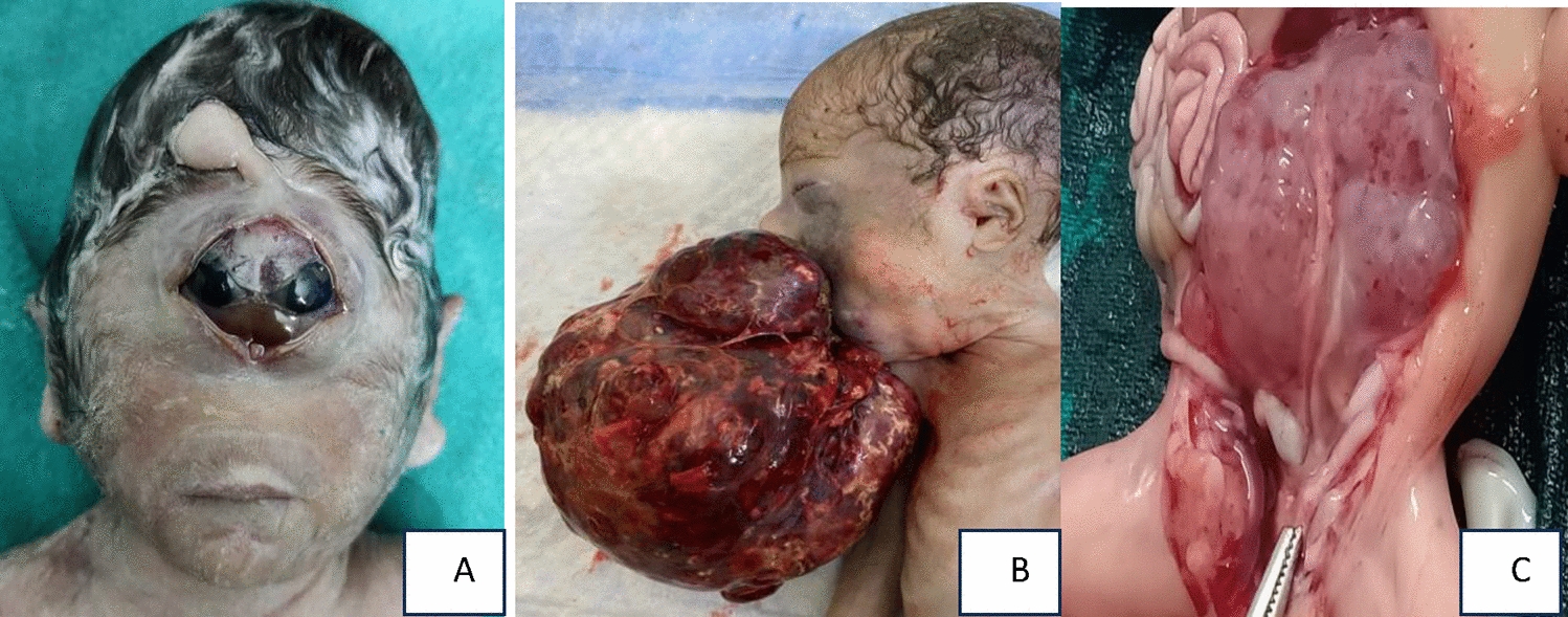 Integration of Prenatal Sonography, Fetal Autopsy, Histopathology and Genetic Tests in Anomalous Fetuses and Diagnostic Yield