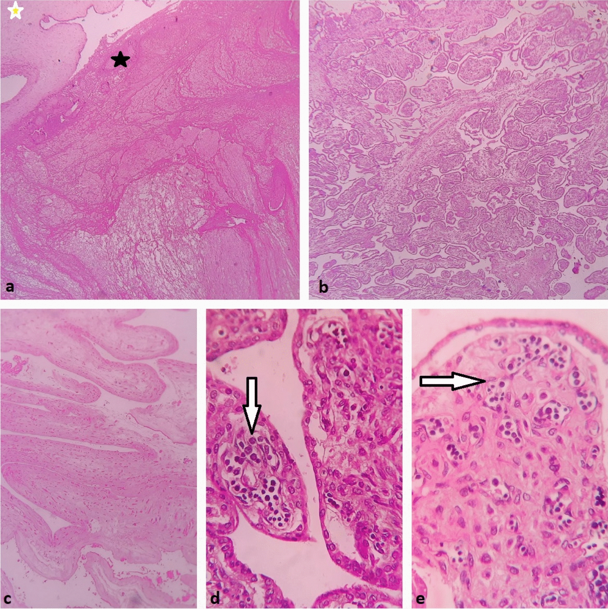 Incidentally Detected Transient Abnormal Myelopoeisis in a Placenta of Mosaic Down’s Syndrome: A Case Report Describing Approach to Diagnosis