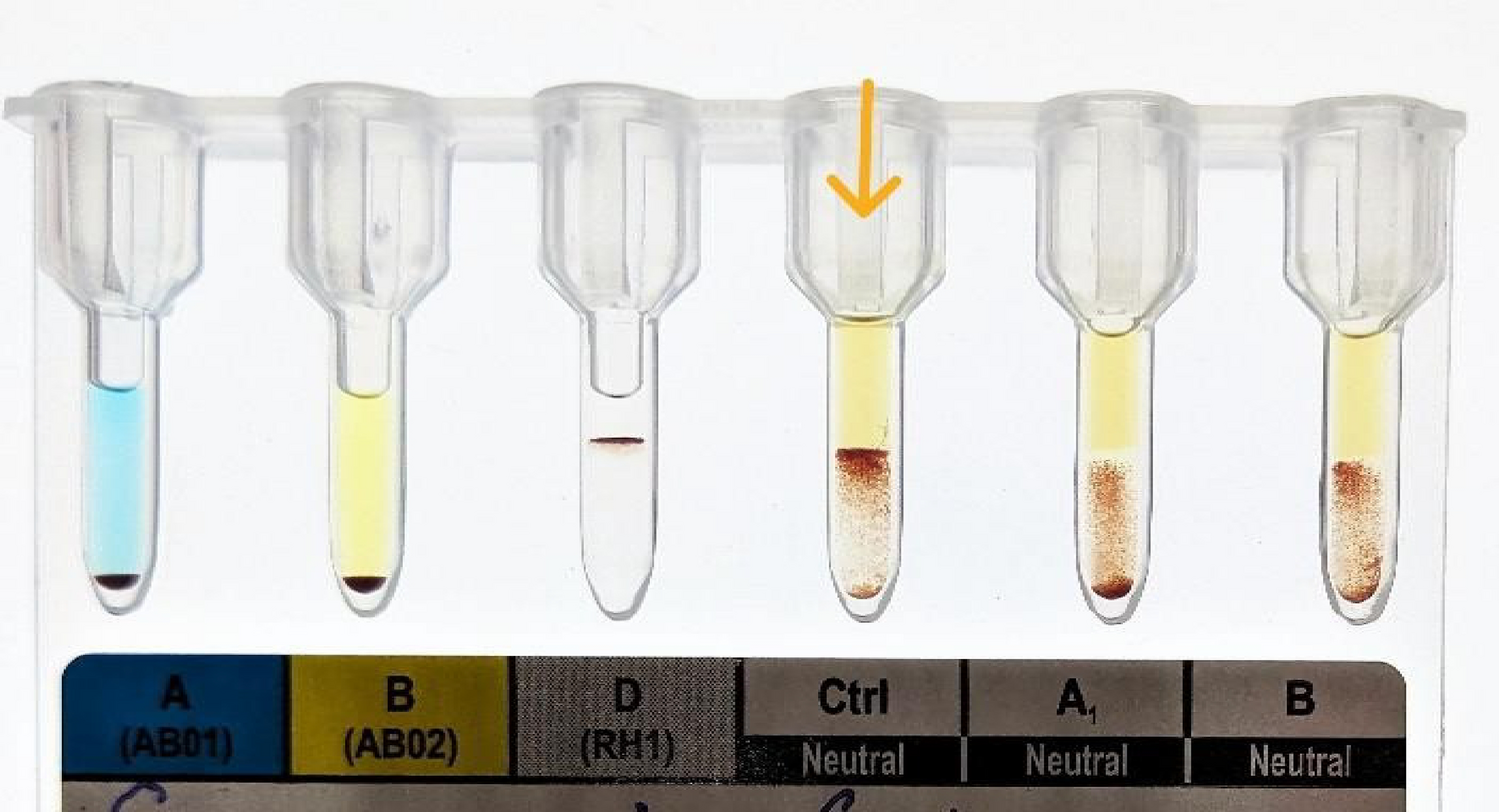 Gynaecological Disorder with Rare Para-Bombay Phenotype: Challenge in Transfusion Support
