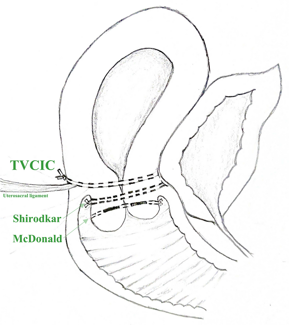 Cervical Insufficiency Management with Elective Transvaginal Cervicoisthmic Cerclage