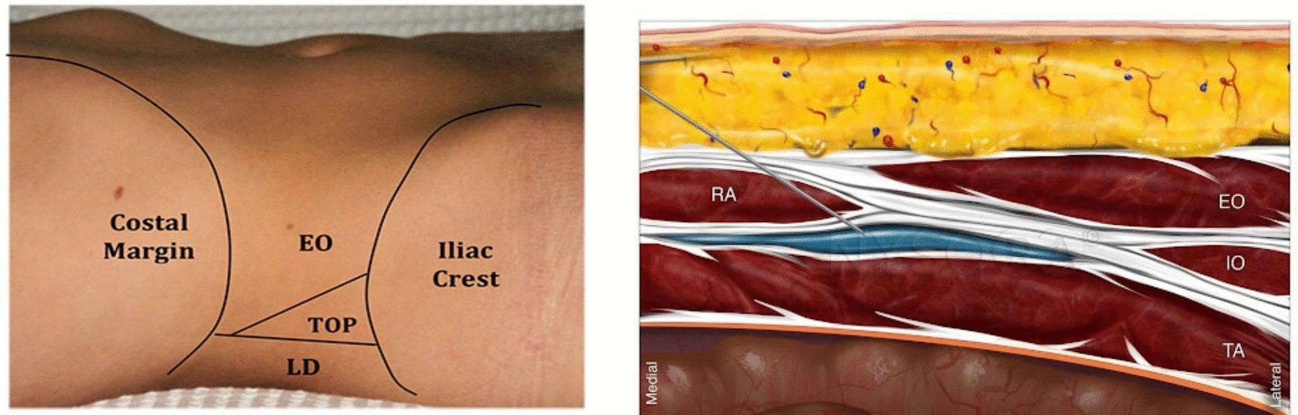 Drug Ropivacaine in Bilateral Transversus Abdominis Plane (TAP) Block Versus Intramuscular Diclofenac Injection for Post-Caesarean Analgesia: Comparing New Method with Traditional One