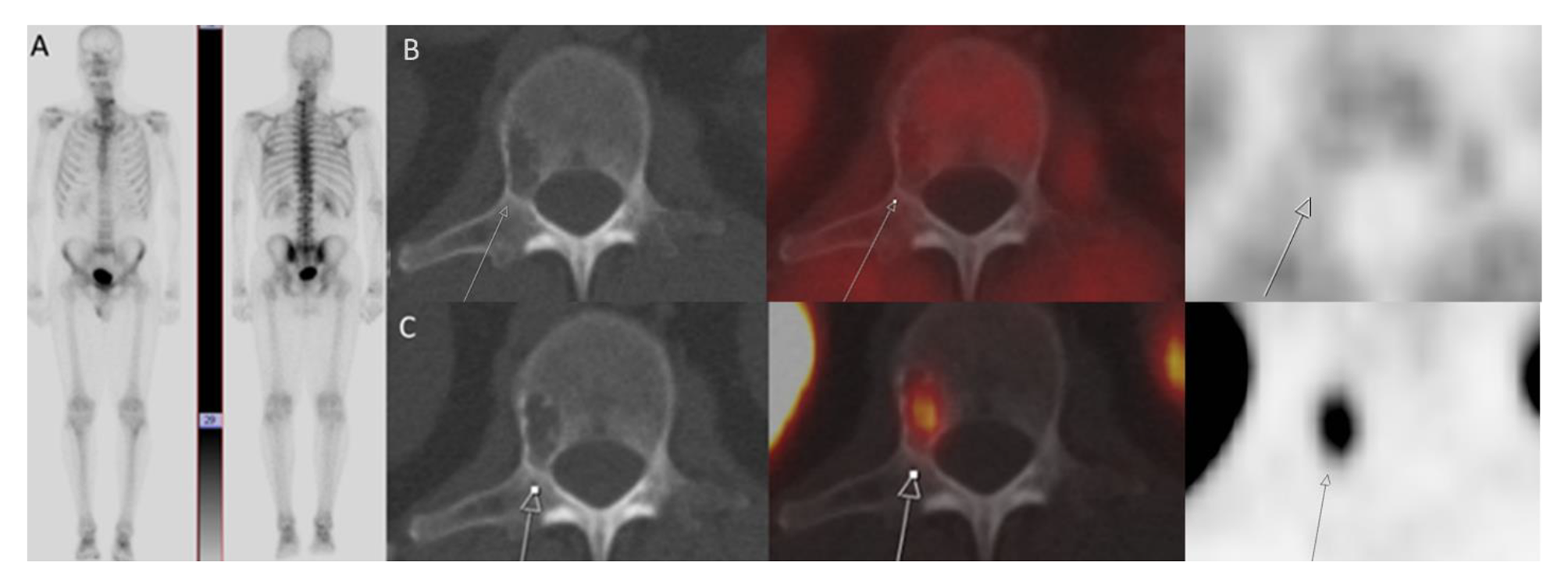 PSMA-expressing, fluciclovine-negative vertebral hemangioma