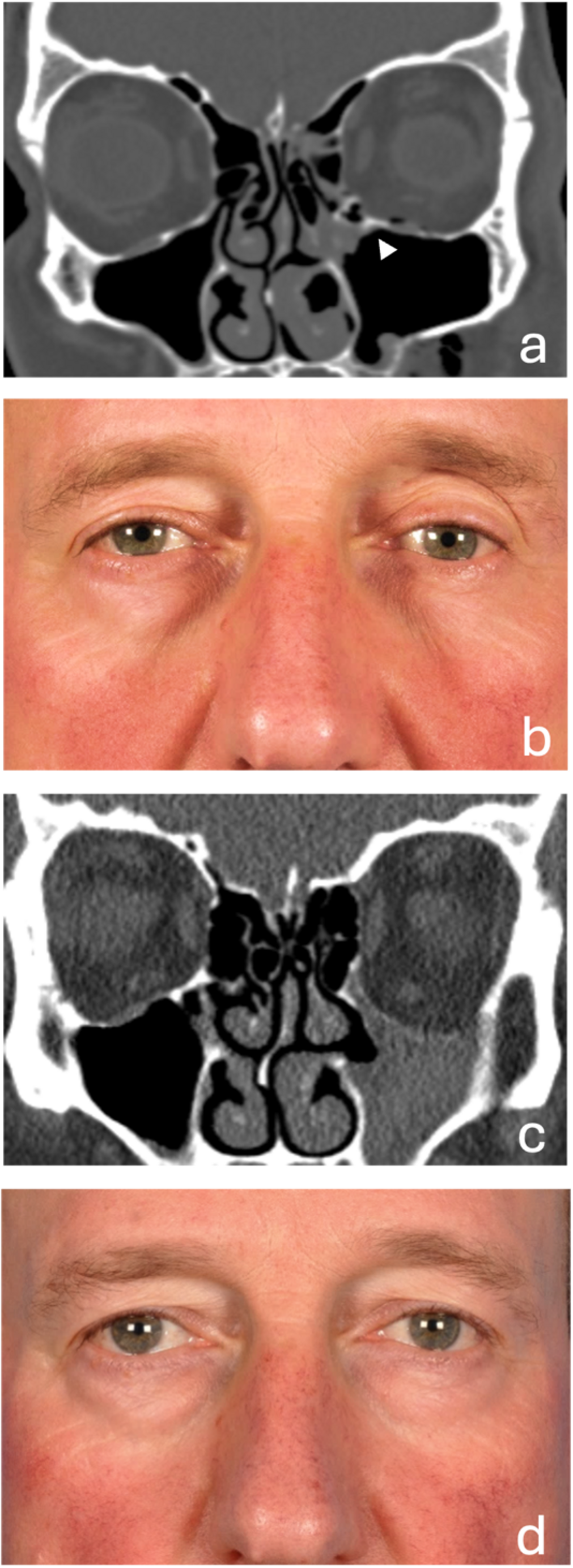 Post-traumatic and iatrogenic silent sinus syndrome: a case series