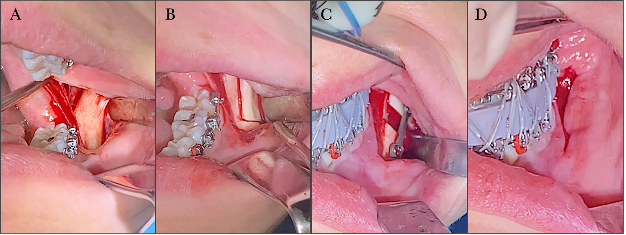 Anterior oblique osteotomy for mandibular advancements: highlighting a minimally invasive solution