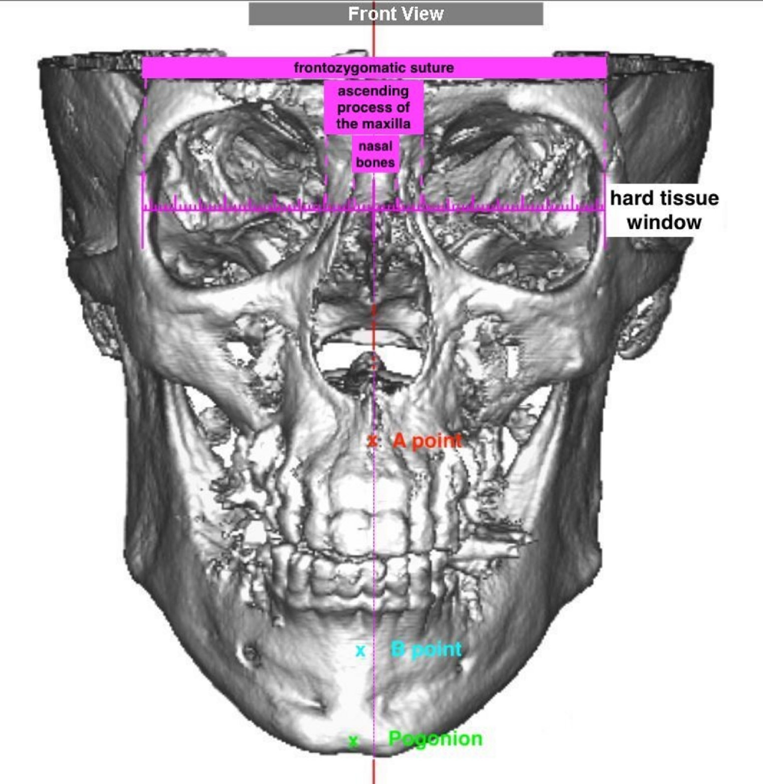 Assessment of the prevalence of nasal deviation in patients requiring orthognathic surgery: association with maxillary, mandibular, or chin asymmetry