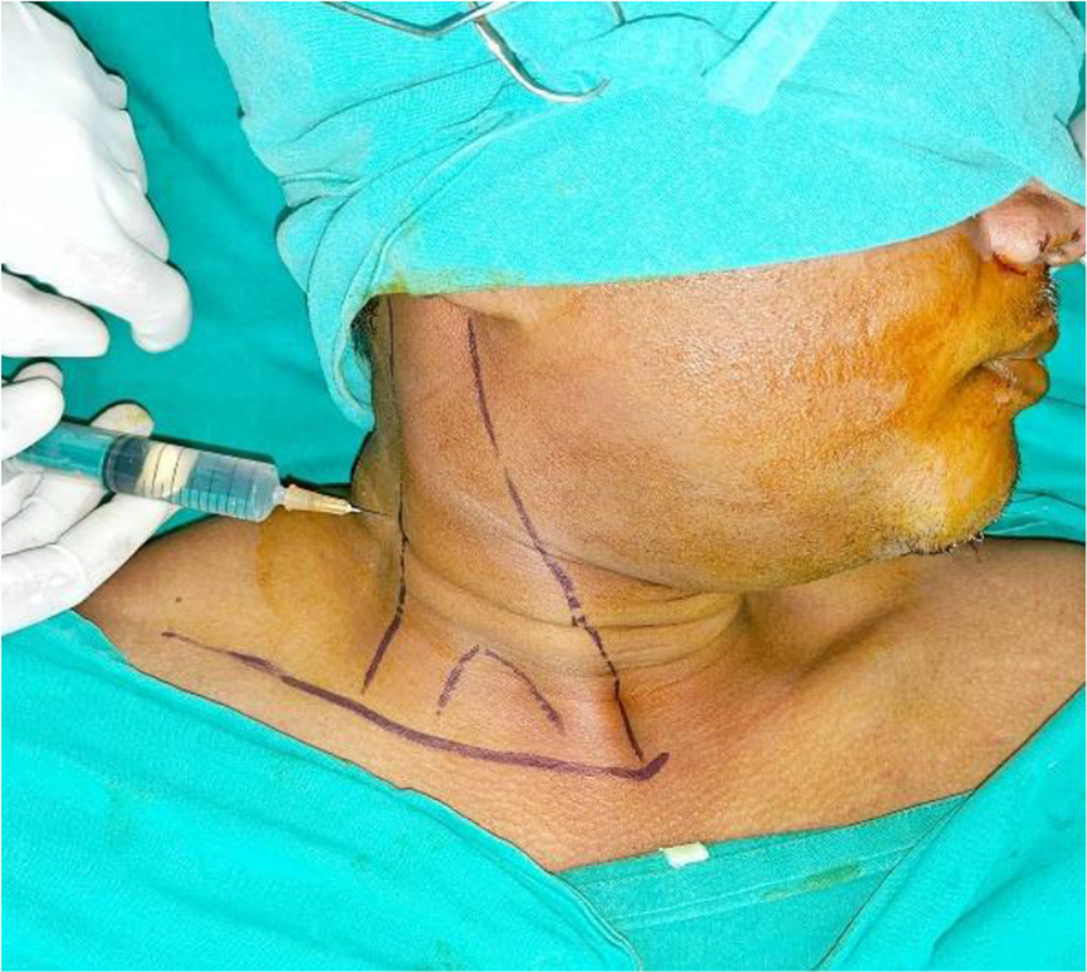 A comparative evaluation of landmark versus modified technique of superficial cervical plexus nerve block in the maxillofacial surgical practice