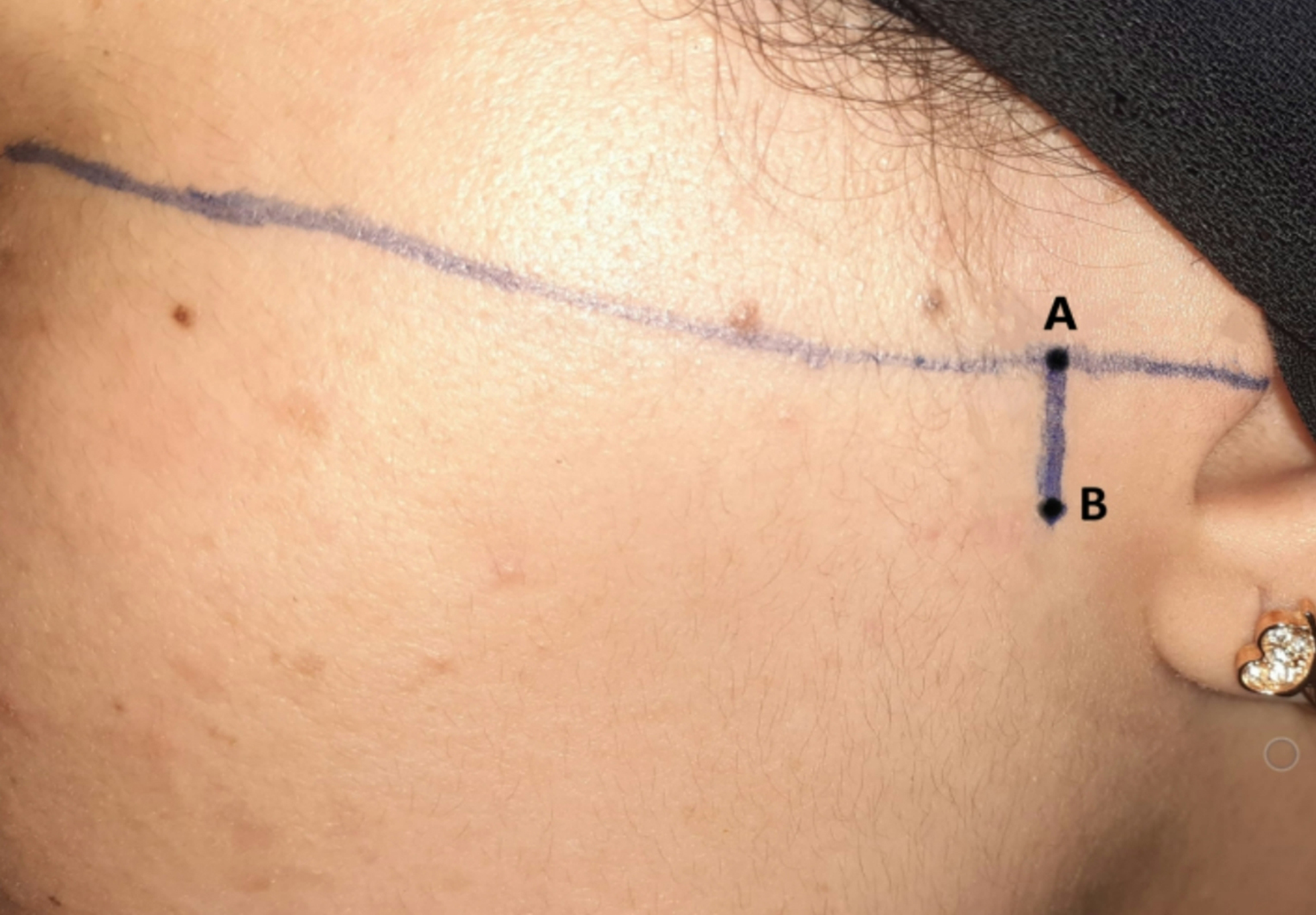 Evaluation of the effectiveness of dextrose injection in improving chewing function in patients with the temporomandibular joint closed lock: a pilot study