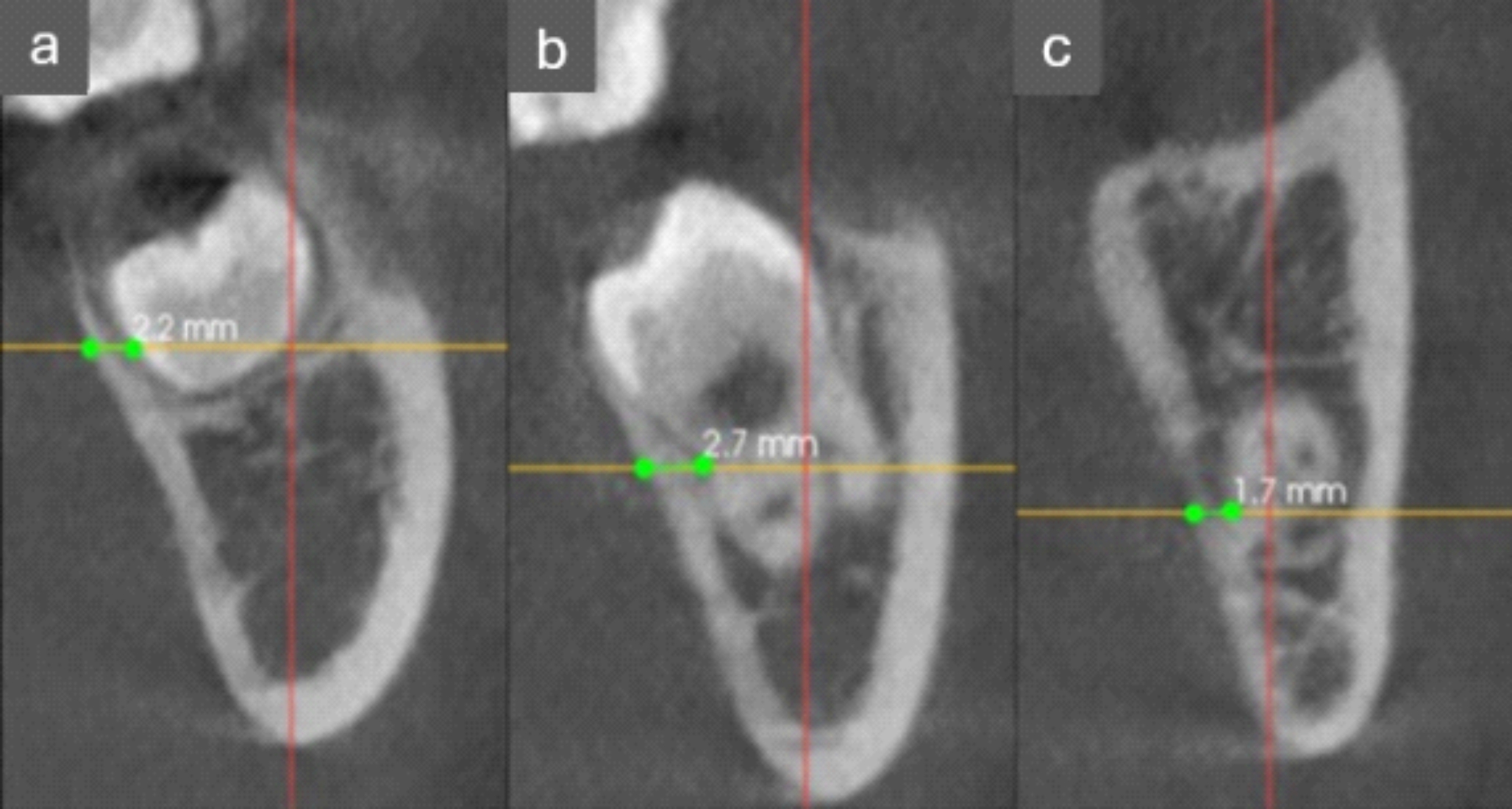 Lingual plate thickness influences cortical bone injury during lower third molar extraction: A cone beam computed tomography study