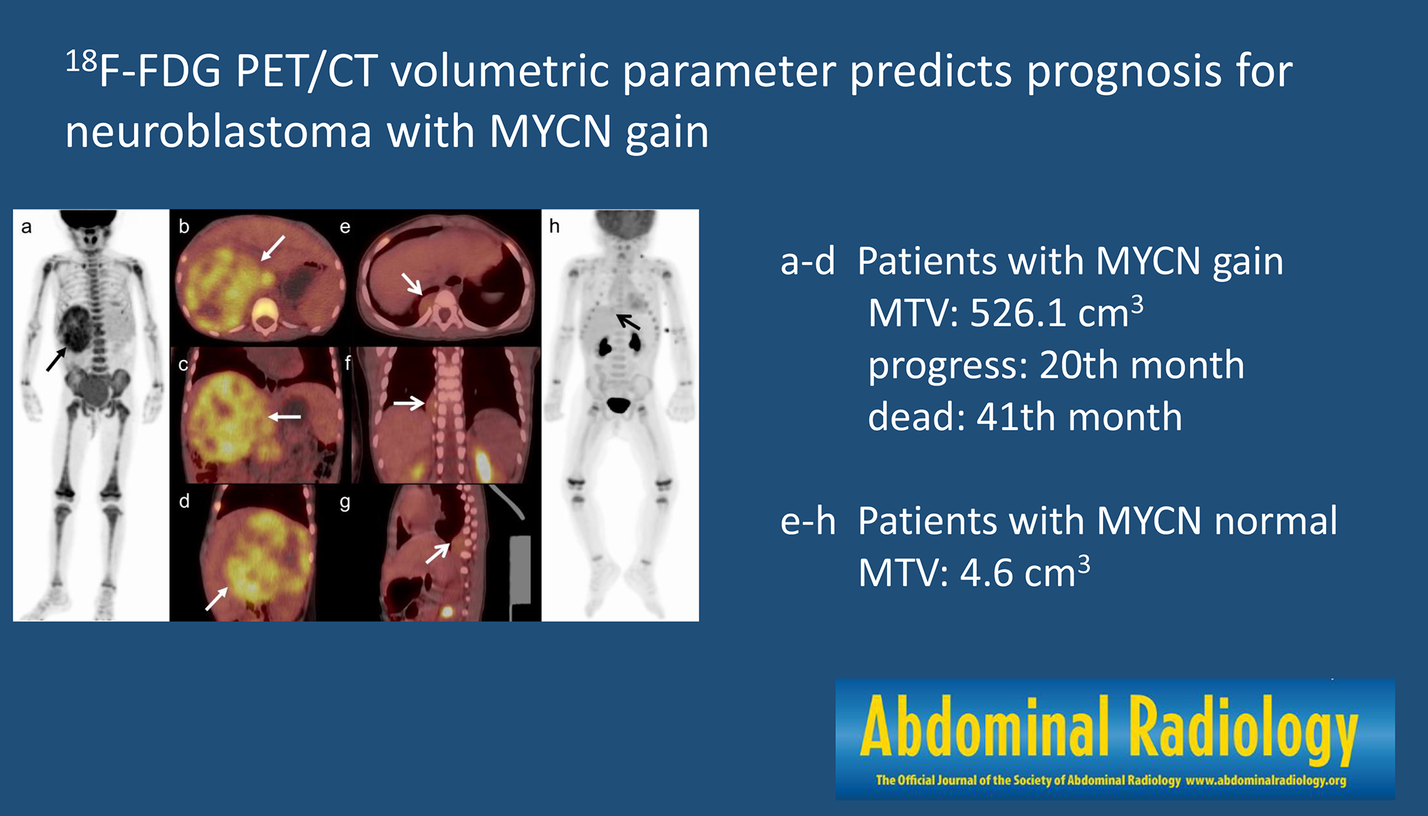 F-FDG PET/CT volumetric parameter predicts prognosis for neuroblastoma with MYCN gain
