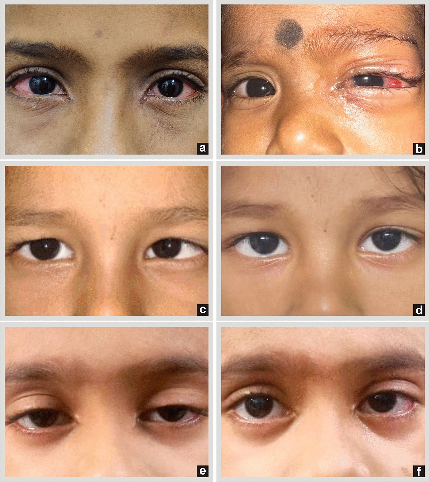 Clinical Spectrum of Ocular Manifestations of Mumps in Children: A Cross-Sectional Study