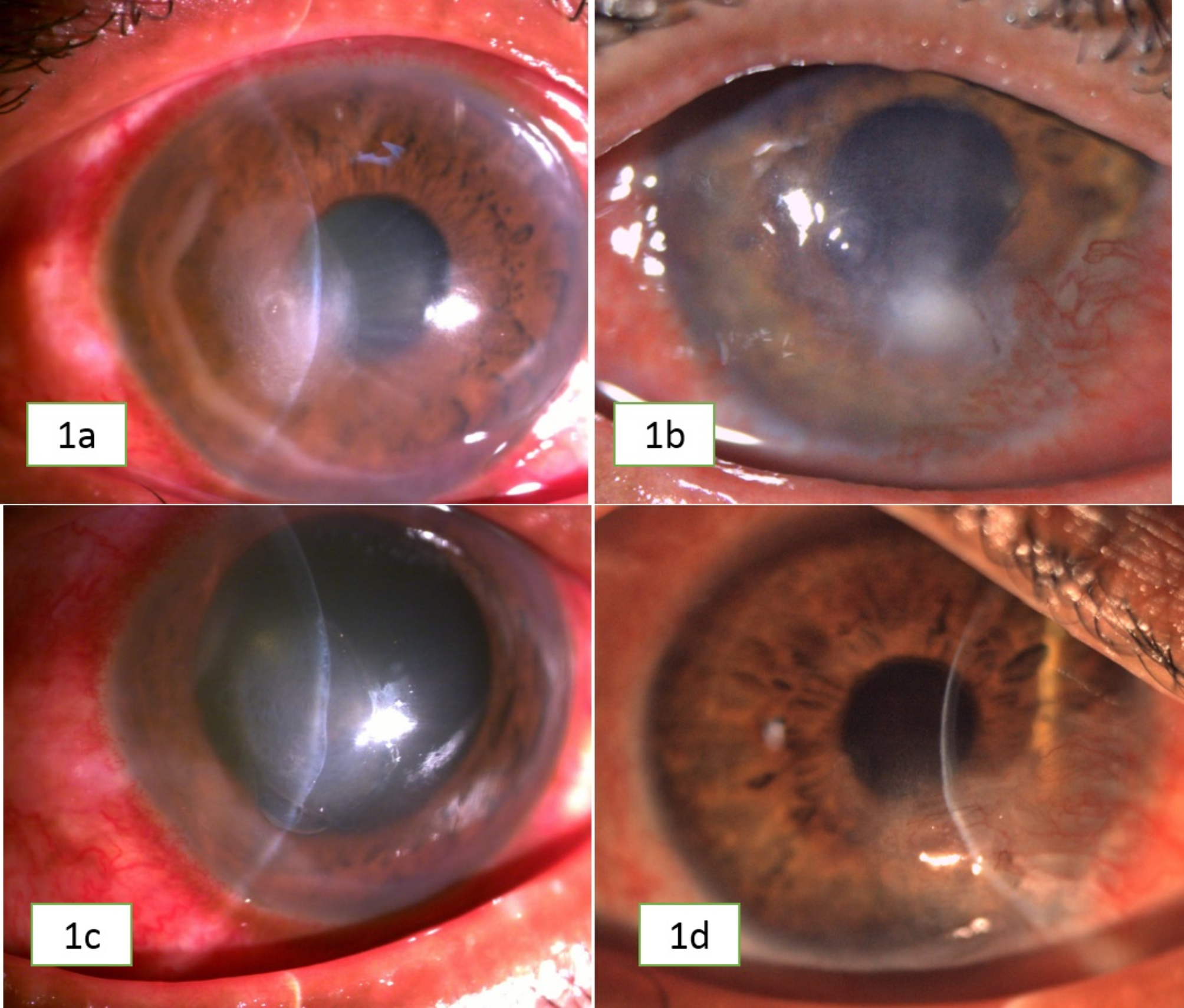 Clinical and microbiological profile of patients with fungal keratitis demonstrating unusual yeast-like structures in potassium hydroxide with calcofluor white preparation of corneal scraping