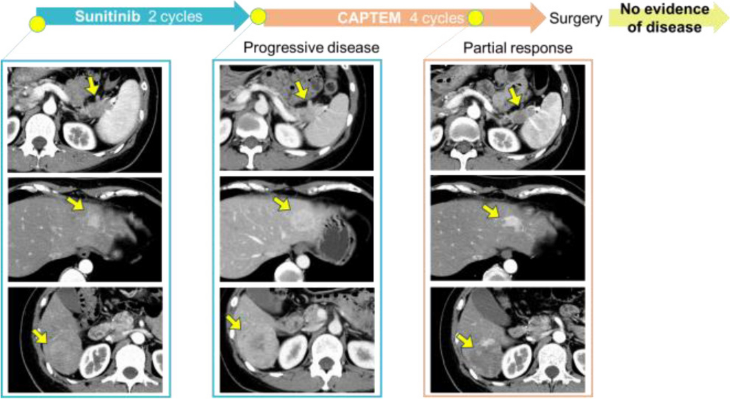 Outcomes of capecitabine plus temozolomide combination therapy in patients with advanced or metastatic pancreatic neuroendocrine tumors: a retrospective observational single-center study