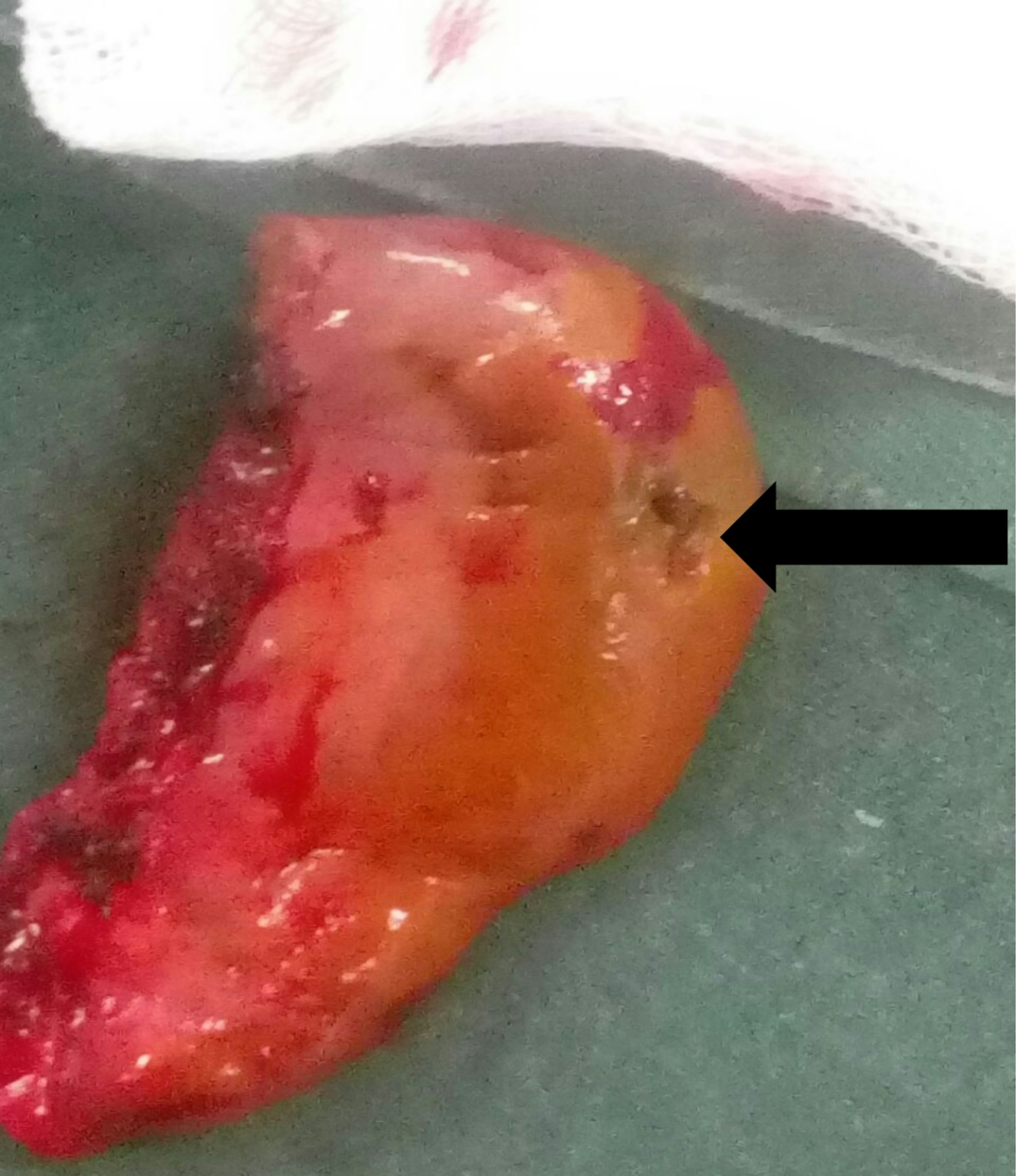 Gallbladder perforation as a rare complication of minor blunt abdominal trauma: a case report