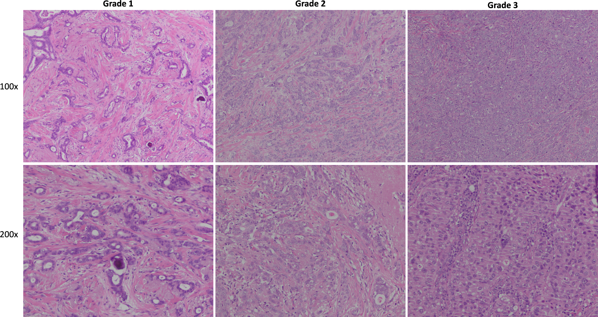 Exploring the Nottingham classification: assessing gene expression profiles in breast cancer patients and their association with outcomes