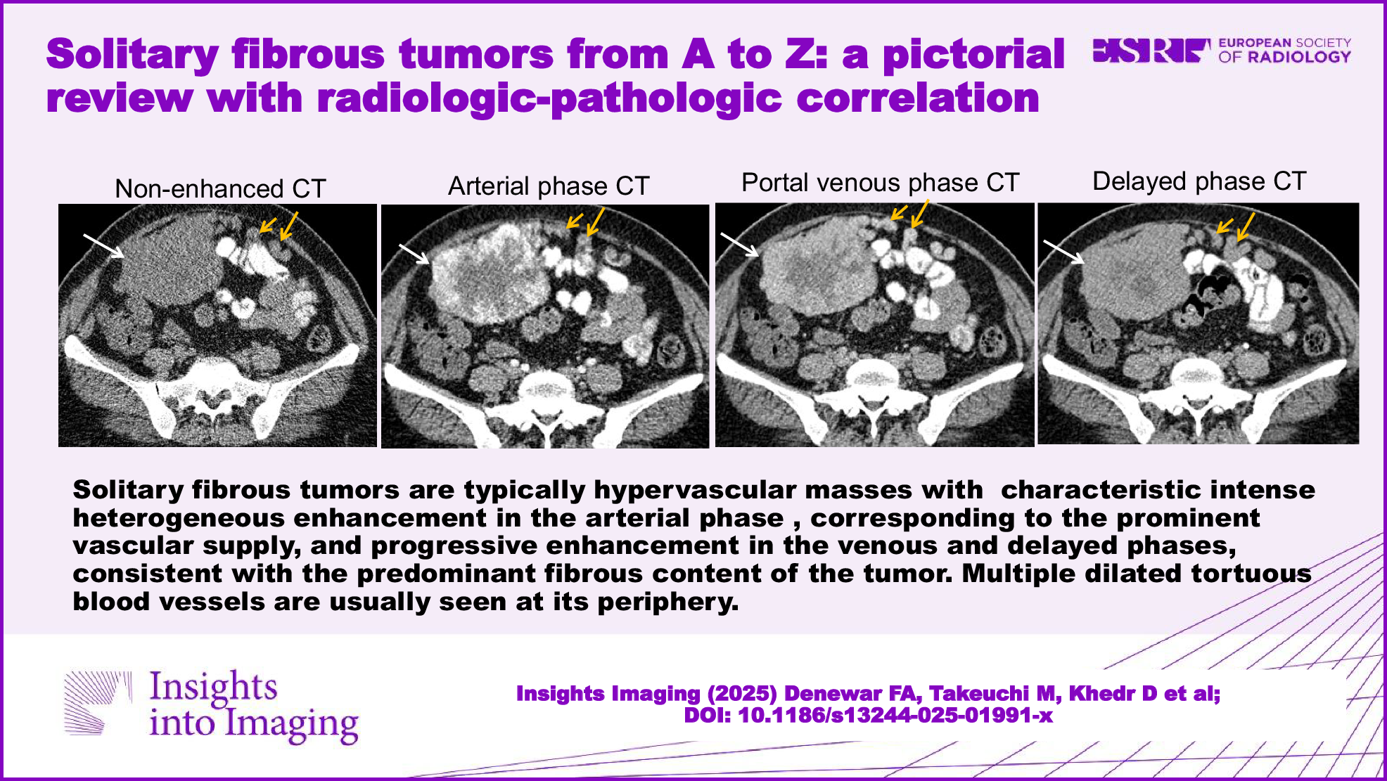 Solitary fibrous tumors from A to Z: a pictorial review with radiologic-pathologic correlation