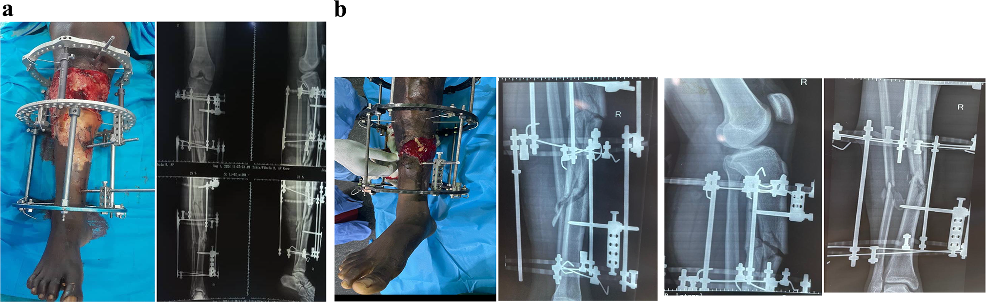 Comparative outcome study of the management of open tibia shaft fractures using Ilizarov frame fixator and linear rail system at University College Hospital, Ibadan, Nigeria