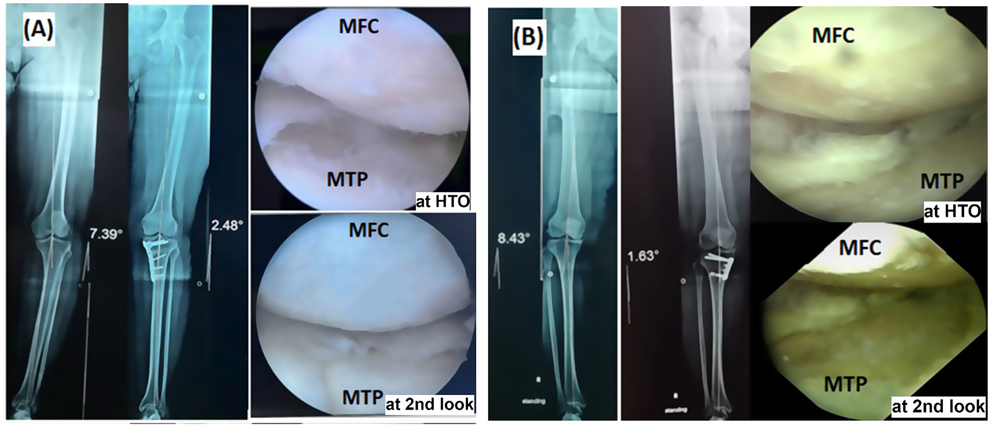 Arthroscopic evidence of improvement in cartilage lesions after medial opening-wedge high-tibial osteotomy with valgus correction and its positive impact on clinical outcomes, a prospective study