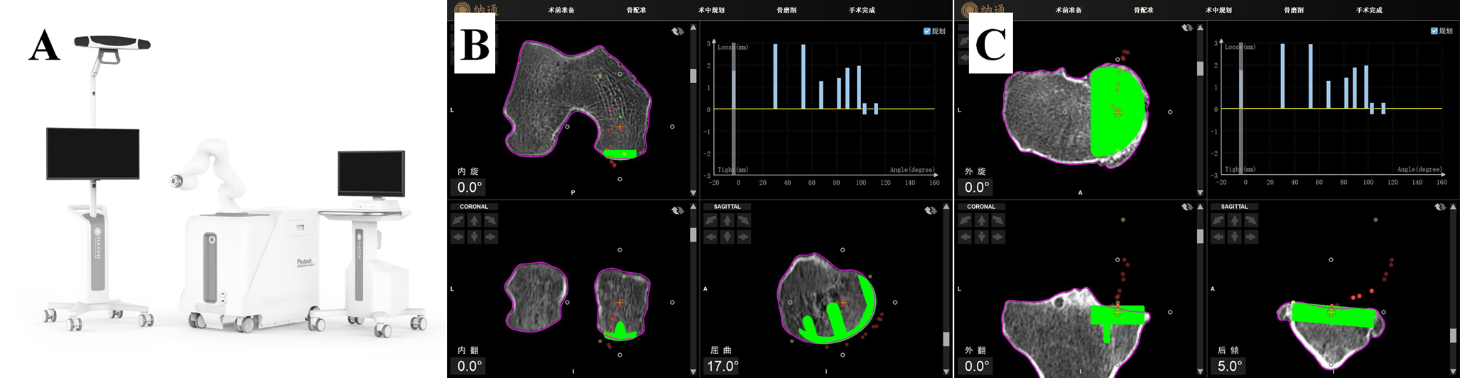 Early clinical outcomes of Naton robotic-assisted medial unicompartmental knee arthroplasty