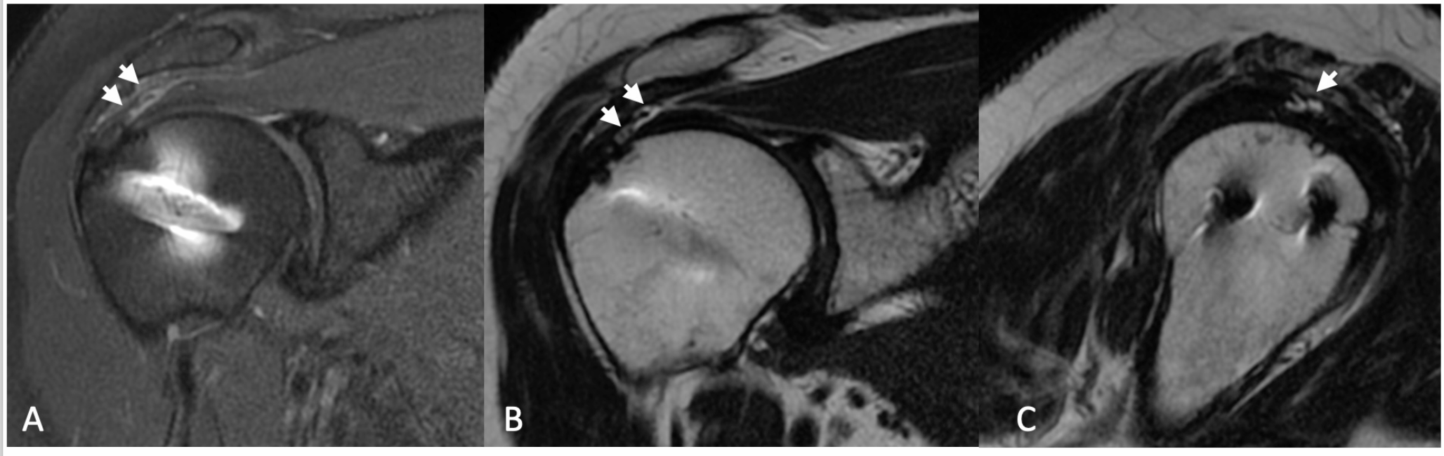 Human dermal allograft augmentation in primary and revision arthroscopic rotator cuff repair: a retrospective controlled study including patient outcomes and ultrasound evaluation of tendon healing