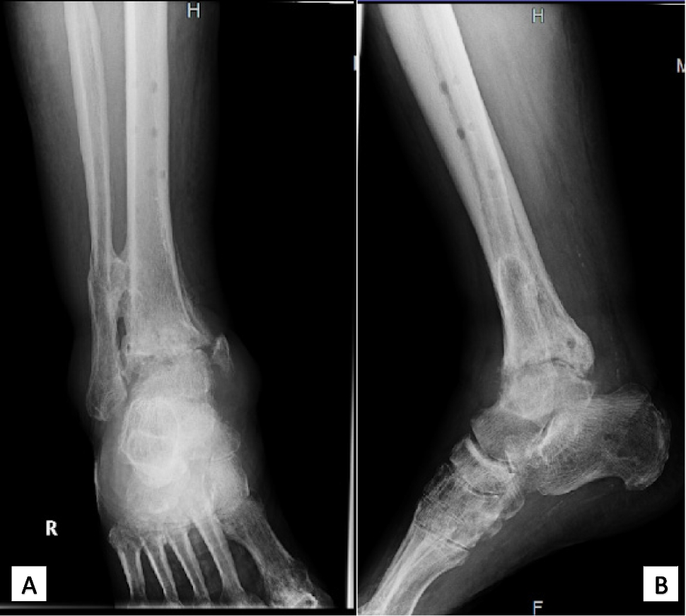 Tibiotalocalcaneal arthrodesis using retrograde nailing (TTCAN) in post-traumatic conditions with high septic risk. Clinical experience