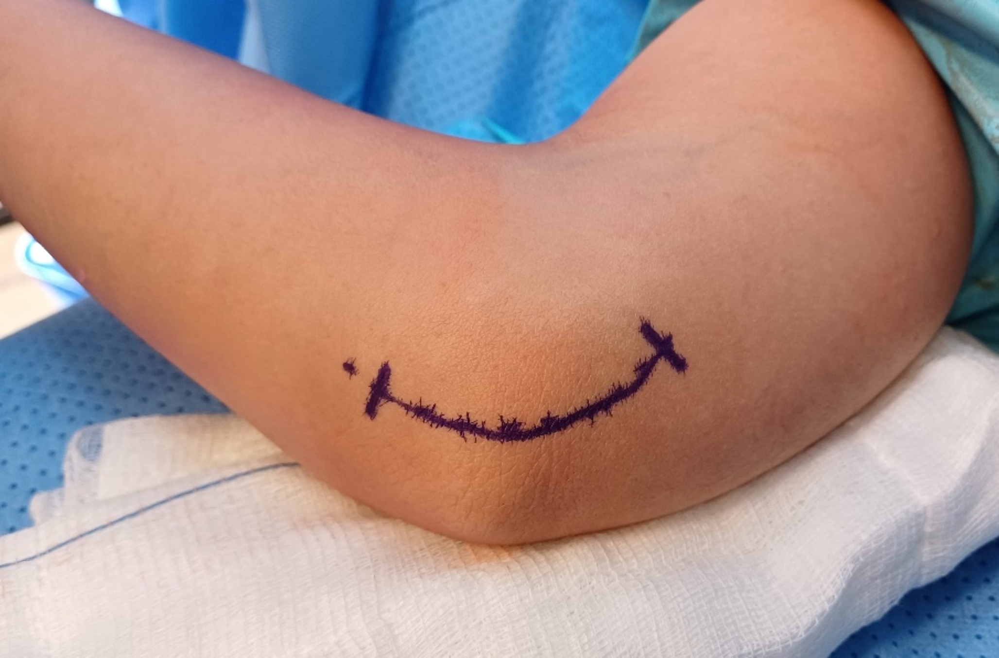 Single incision surgical approach for the release of lacertus syndrome and cubital tunnel syndrome