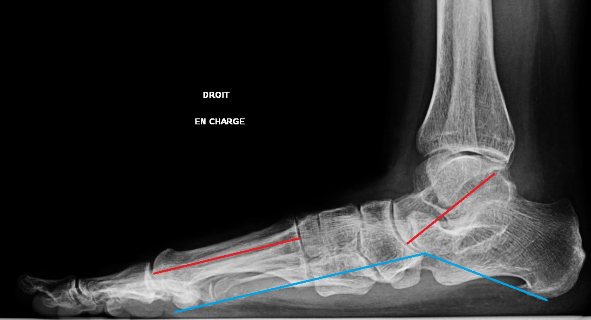 Long-term follow-up of the medial arch correction with calcaneal medialization osteotomy in progressive collapsing foot deformity