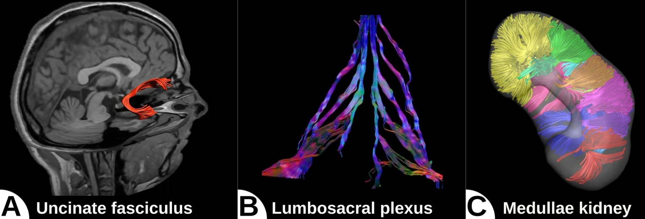DTI-based fiber tractography: why not?