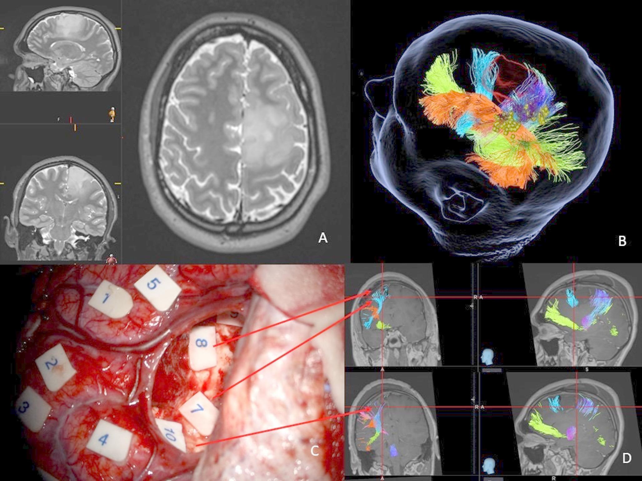 DEBATE: is tractography accurate enough to be used to inform surgery?