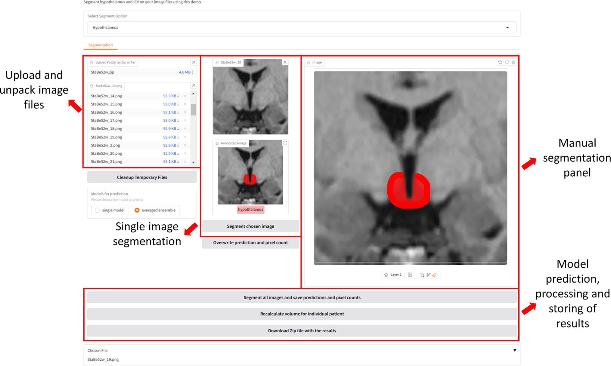 Hypothalamus and intracranial volume segmentation at the group level by use of a Gradio-CNN framework