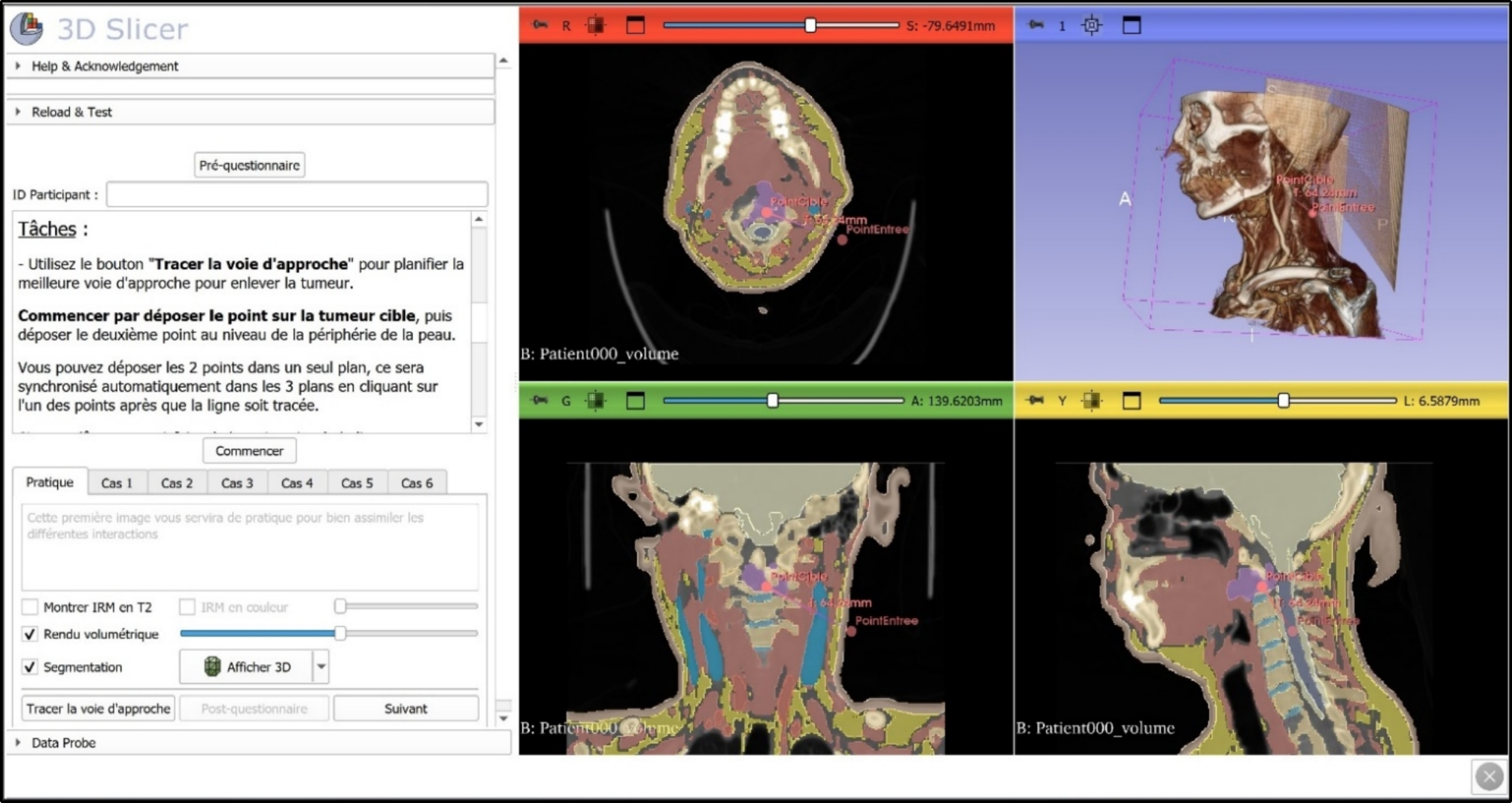 Evaluating virtual reality as a tool for improving surgical planning in spinal tumors