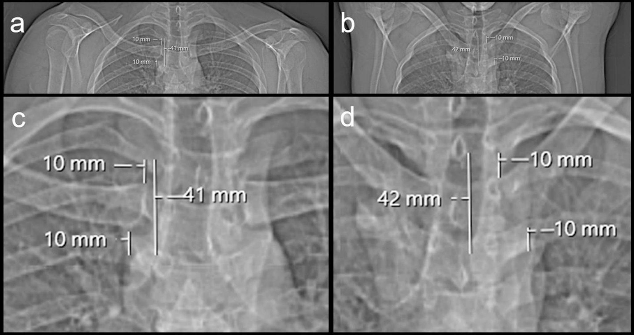 CT of the medial clavicular epiphysis for forensic age estimation – raised arms position recommended