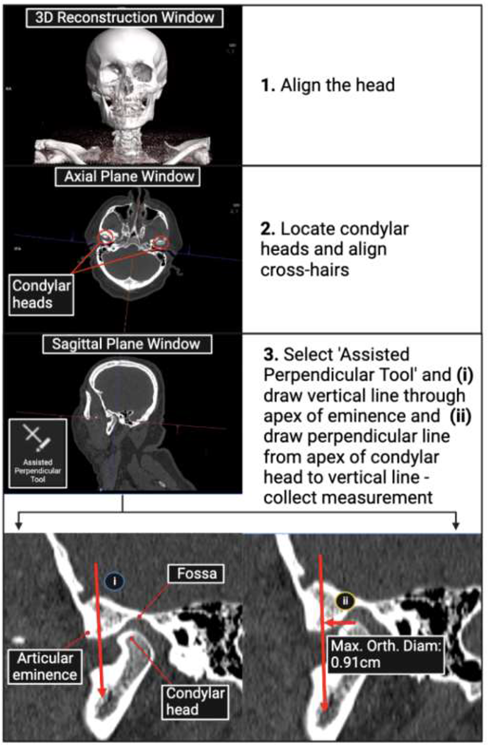 Determination of normal post-mortem computed tomography (PMCT) parameters for the temporomandibular joint