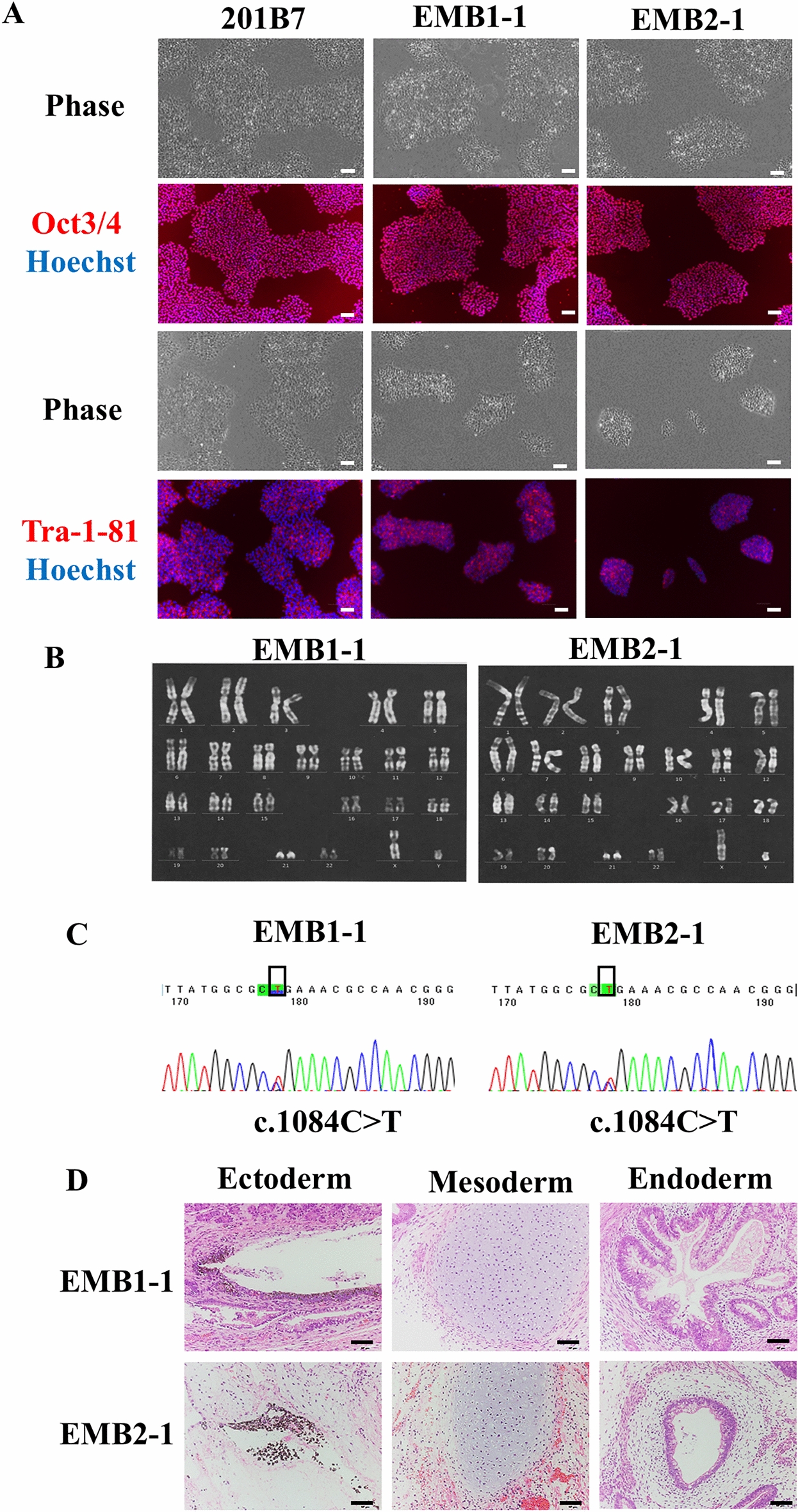 A pluripotent stem cell model of Emberger syndrome reveals reduced lymphatic endothelial differentiation