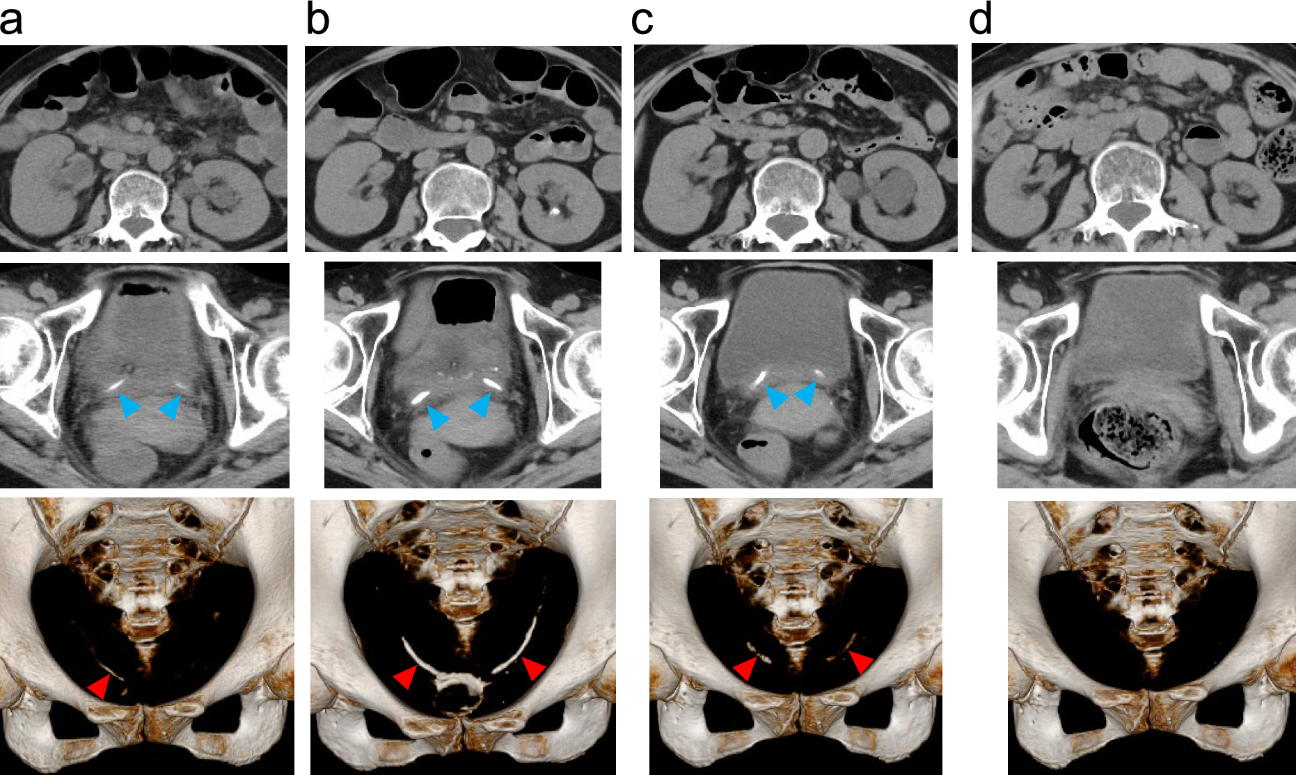 Transient bilateral ureteral stones in a patient with BK viral infection after hematopoietic stem cell transplantation