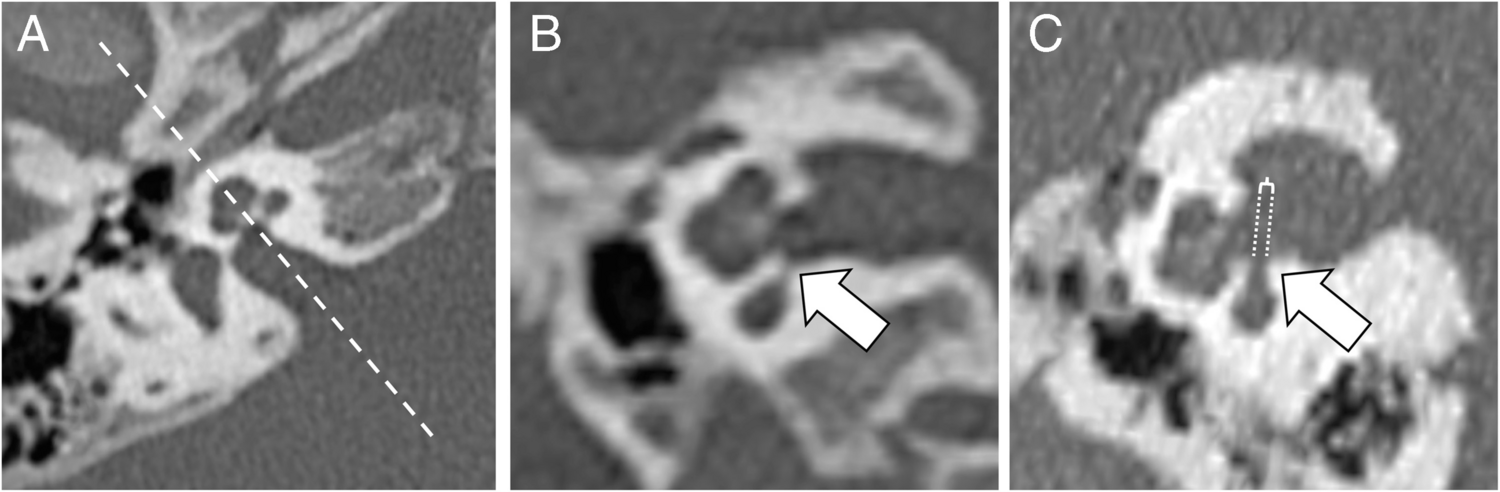 Evaluation of Cochlear Basal Turn Patency in Children with Hearing Loss