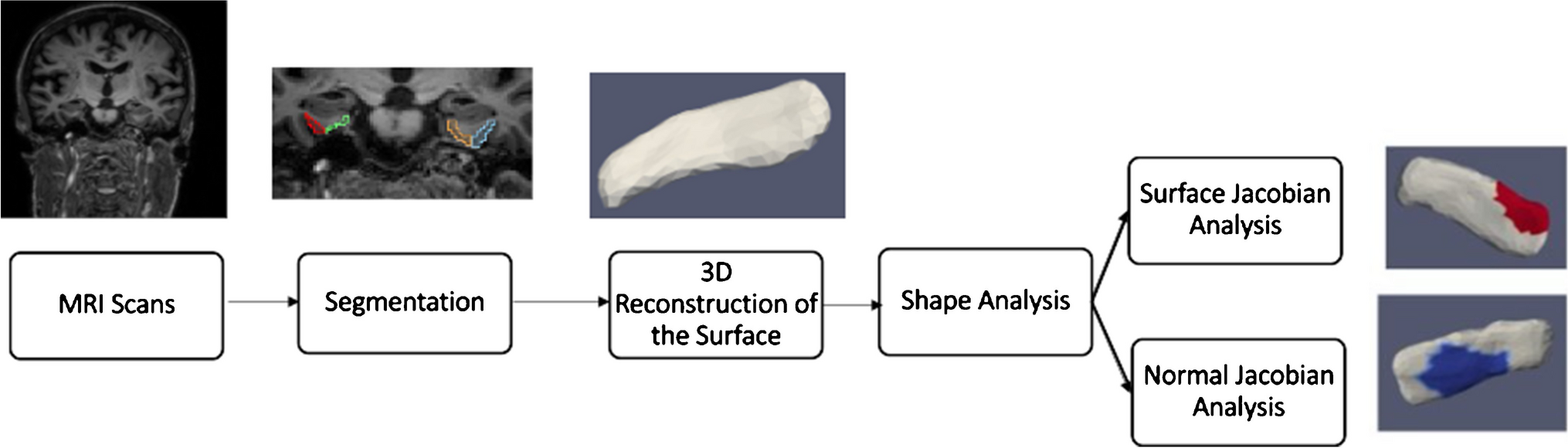 The Inner Ear and Aging Brain: A Cross-Sectional Study of Vestibular Function and Morphometric Variations in the Entorhinal and Trans-Entorhinal Cortex