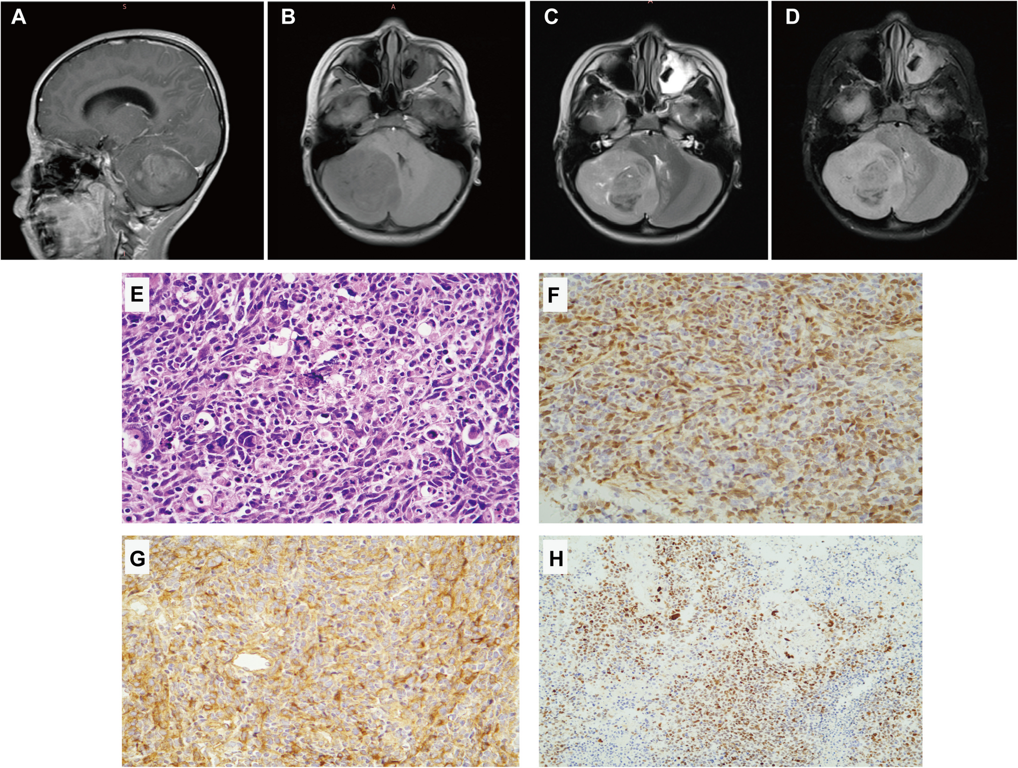 Medulloblastoma associated with Lynch syndrome: a case report of germline  variant and tumor molecular characterization