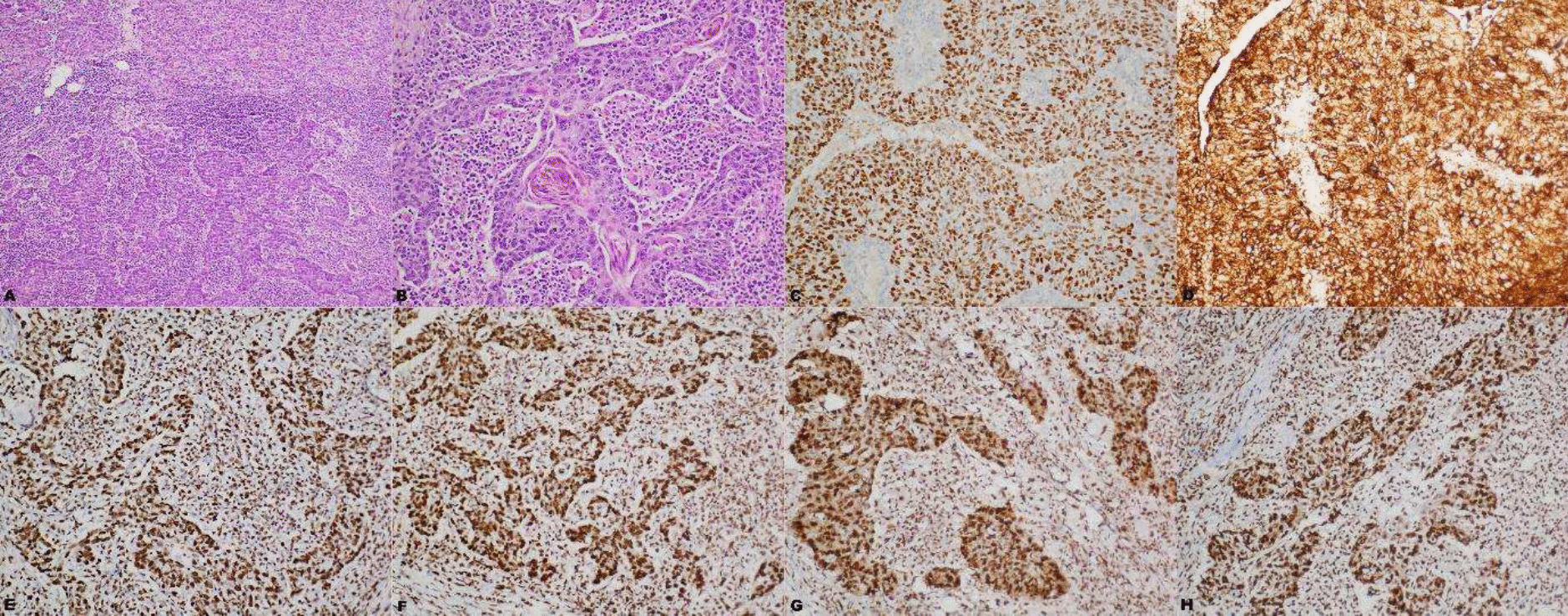 Isolated Pancreatic Metastasis from Esophageal Squamous Cell Carcinoma: A Rare Case Report with Review of Literature