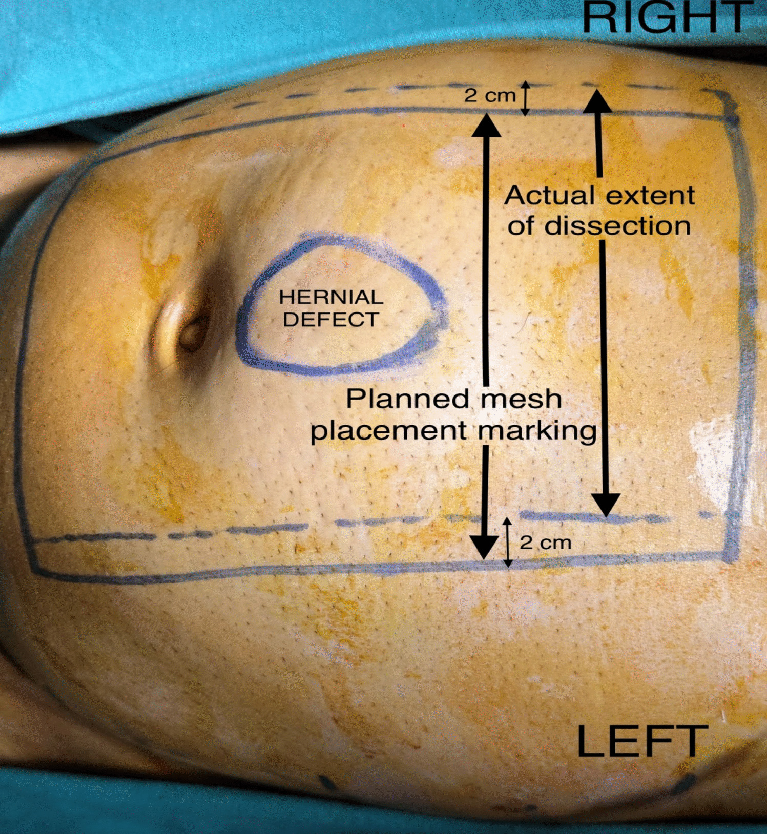 A Retrospective Cohort Study Comparing Short-Term Outcomes of Enhanced Total Extraperitoneal (eTEP) and Robotic Transabdominal Pre-peritoneal (rTAPP) Mesh Repairs for Primary Midline Ventral Hernias (PMVH)