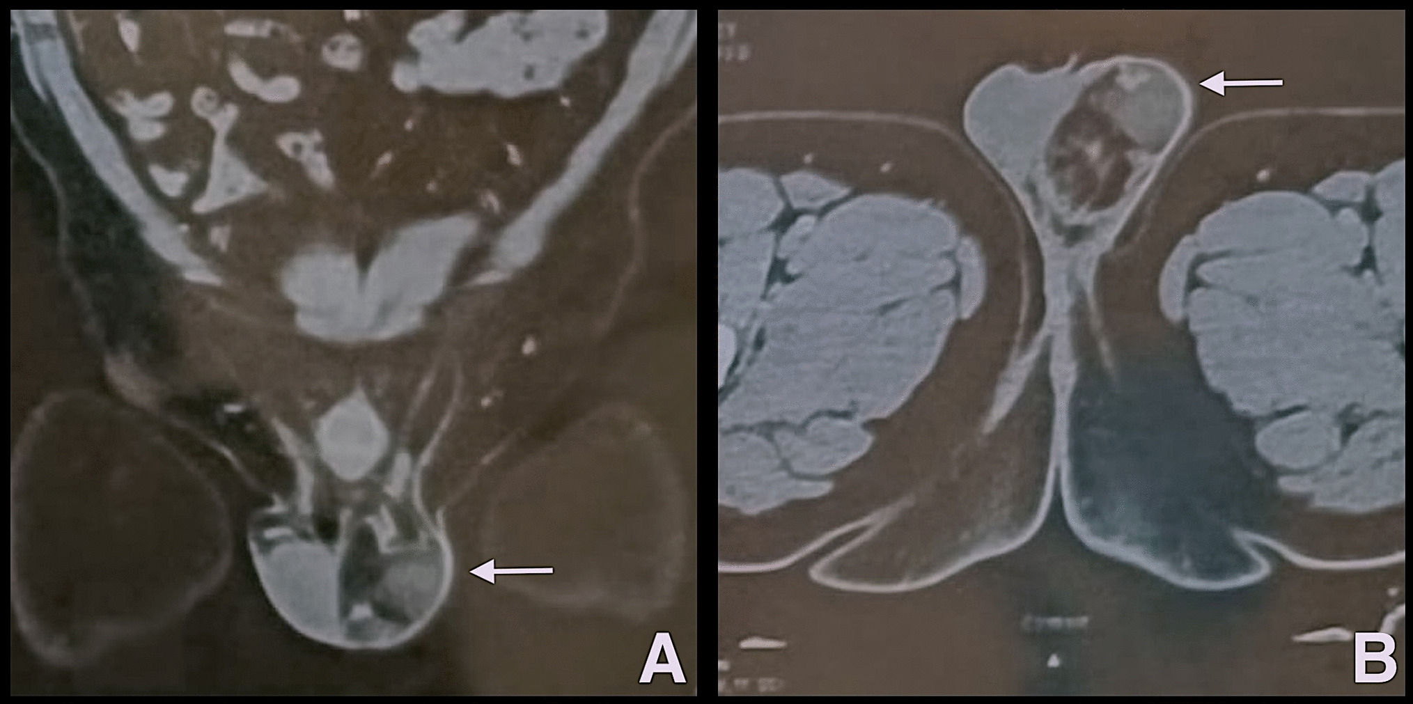 Unusual Scrotal Swelling: A Rare Case of Paratesticular Liposarcoma and Literature Review