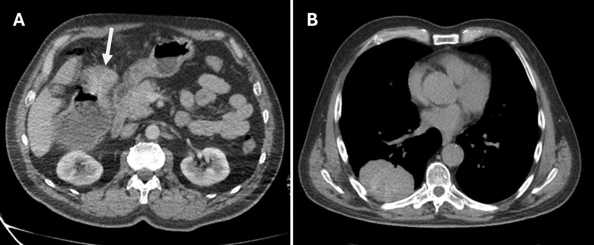 Tumor to Tumor Metastasis in Lung Mass: A Rare Case of Colon Adenocarcinoma Metastasis to Large Cell Lung Cancer
