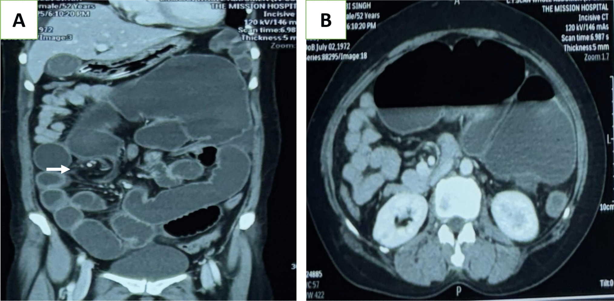 The Twisted Colon: A Rare Case of Acute Cecal Volvulus