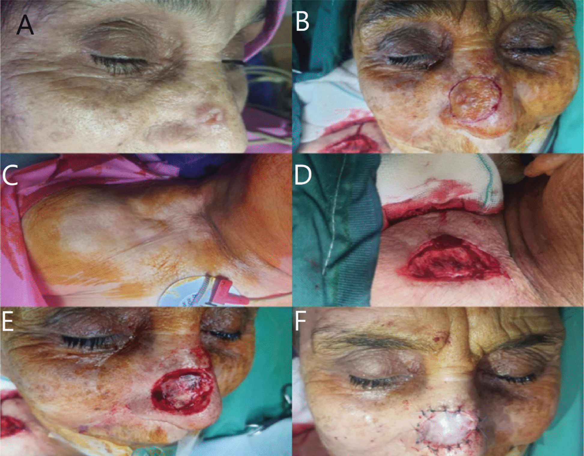 Evaluation of Cosmetic and Pathological Outcomes of Nasal BCC Resection and Supraclavicular Full-Thickness Graft Reconstruction