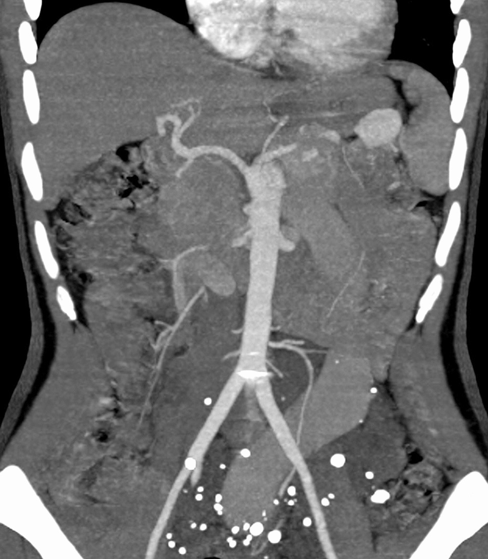 An Unexpected Case of Abernethy Type 1b Malformation