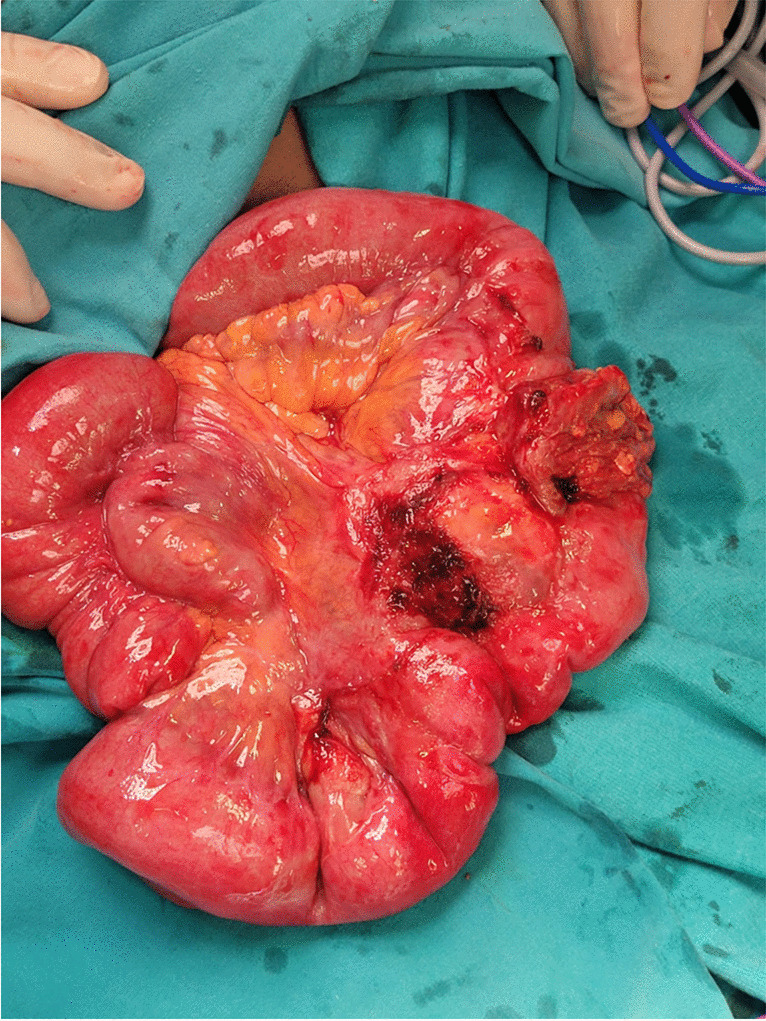 A Rare Cause of Acute Abdomen in Adults: Jejunal Tubular Duplication