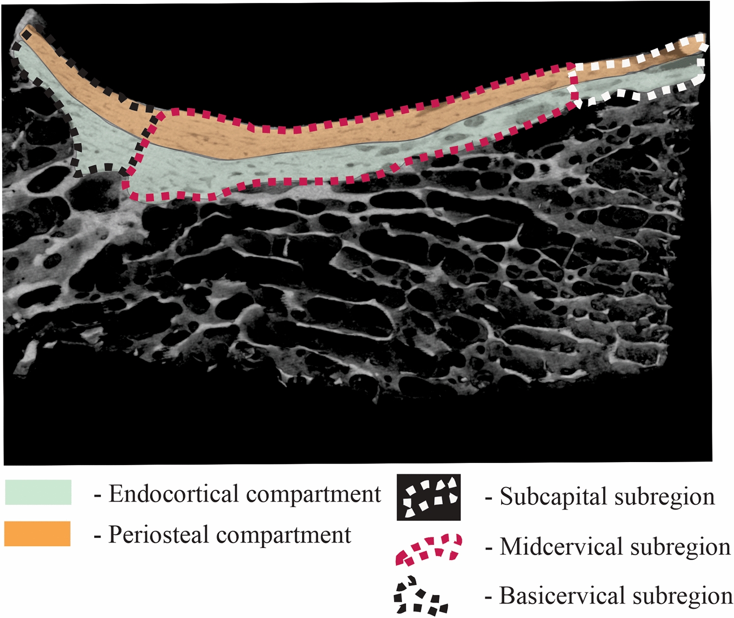 Characterization of Bone Matrix Mineralization and Osteocyte Lacunar Density Unveils Microstructural Impairment at the Main Femoral Fracture-Initiating Site in Type 2 Diabetes Mellitus