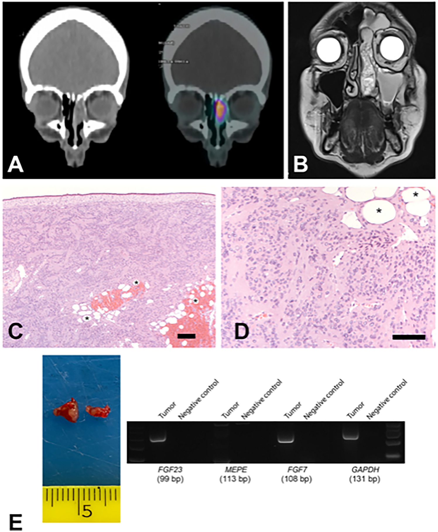 Exploring the Role of FGF7 in Tumor-Induced Osteomalacia. Clinic–Pathologic Analysis in a Patient with a Sino-Nasal Phosphaturic Mesenchymal Tumor