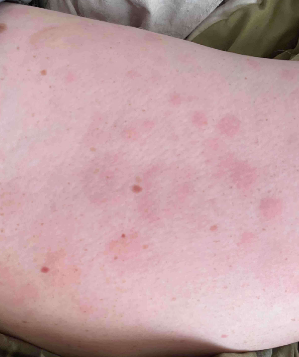 Novel desensitization protocol utilizing conventional formulations to mitigate Temozolomide-Related skin hypersensitivity