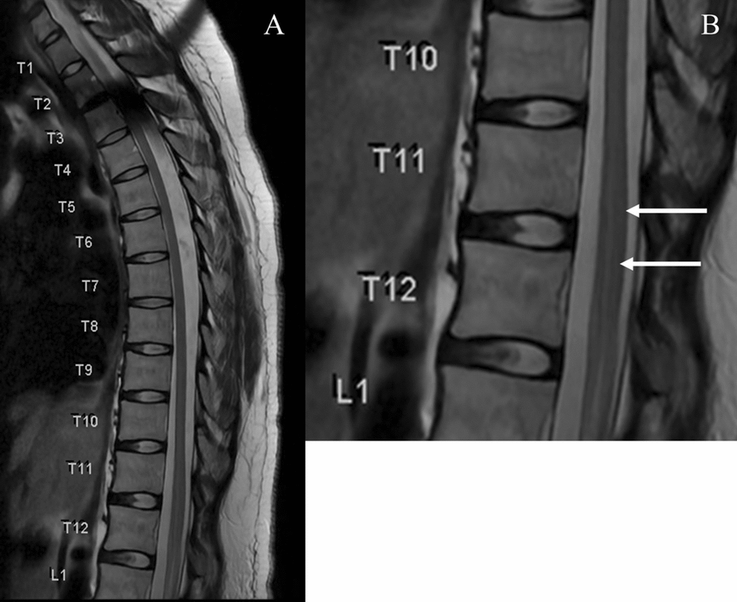 Peripartum transverse myelitis with intrathecal catheter placement after unintentional dural puncture